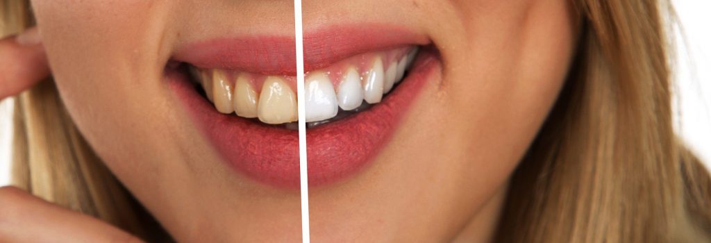 تبييض الأسنان و 4 نصائح قبلية